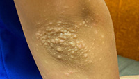 Frictional lichenoid dermatitis